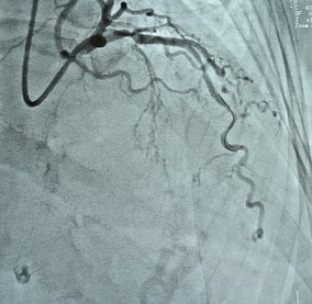 Coronary Intervention